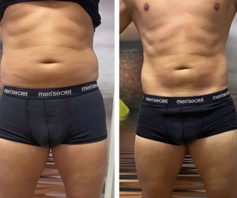 Body restoration results — Skin Tightening